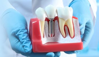 Can Dental Implants Cause Sensitivity to Cold Temperatures?